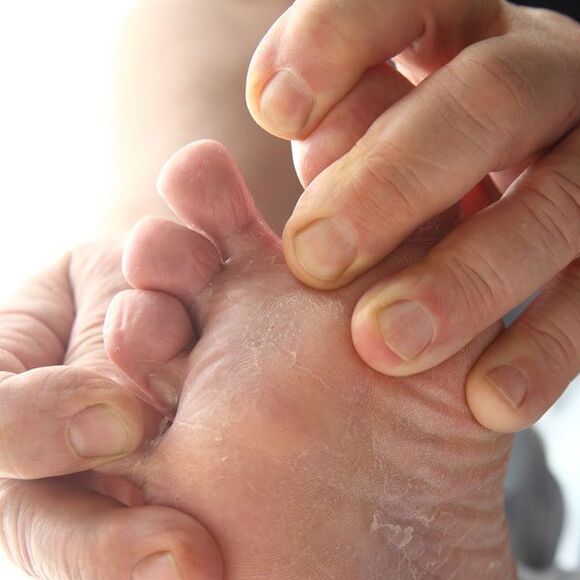 Mantar ayak parmakları arasındaki cildi etkiler